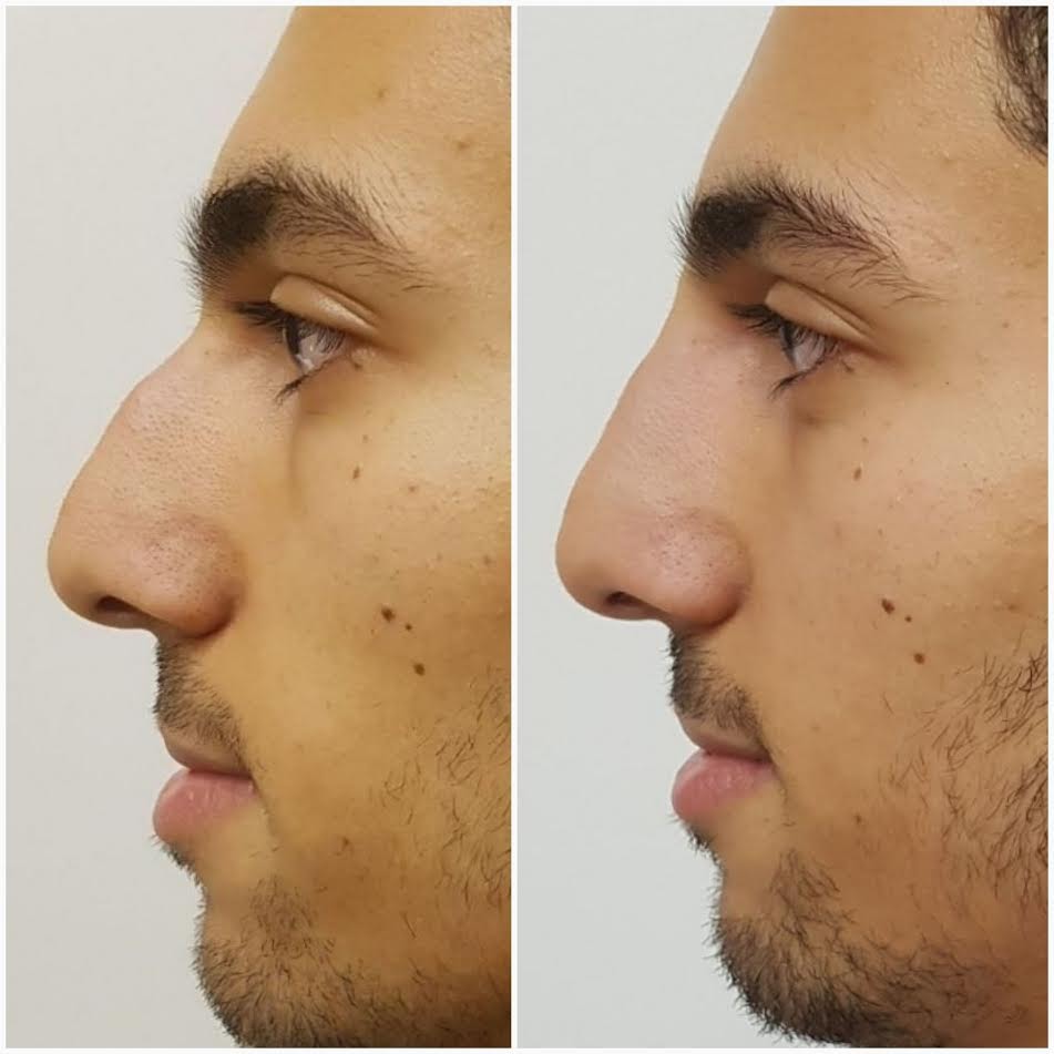 NonSurgical Nose Enhancement