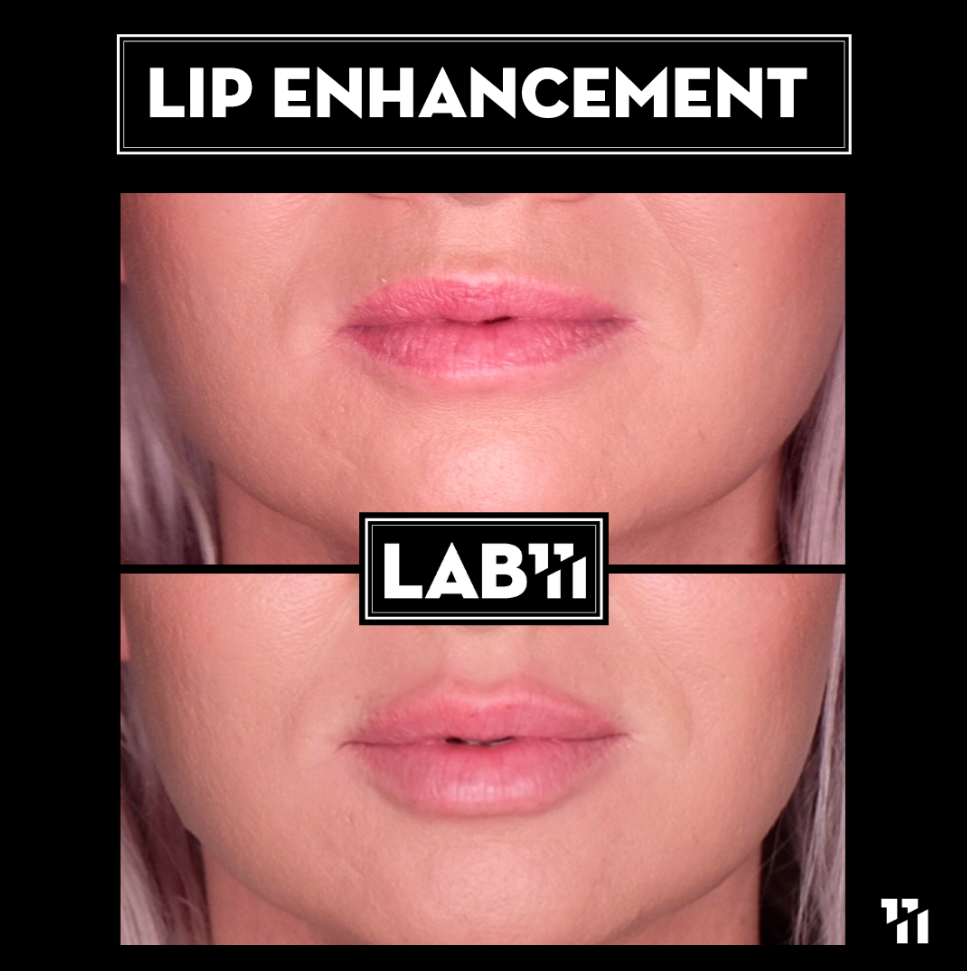Lip Enhancement Before After