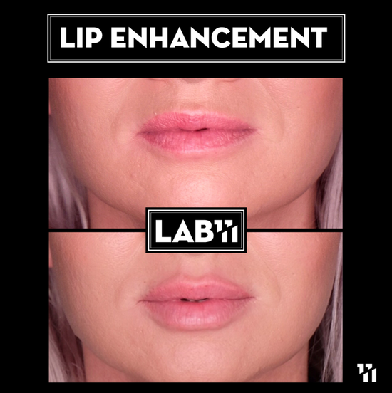 Lip Enhancement Before After